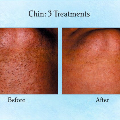 Chin: 3 Treatments
