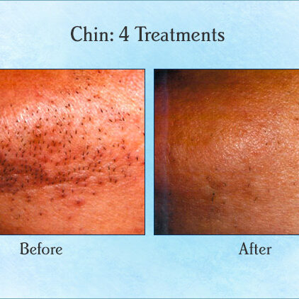 Chin: 4 Treatments