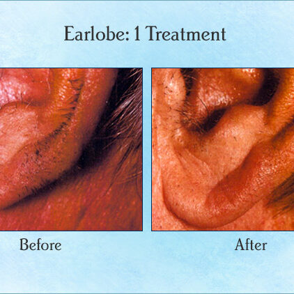 Earlobe: 1 Treatment