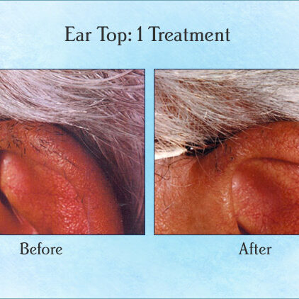 Ear Top: 1 Treatment