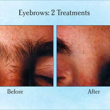 Eyebrows: 2 Treatments