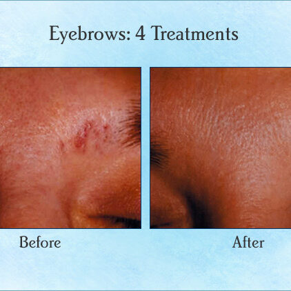 Eyebrows: 4 Treatments
