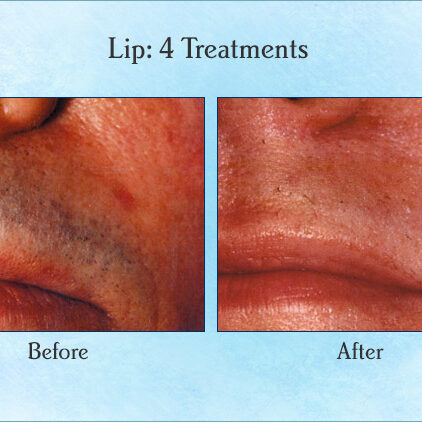 Lip: 4 Treatments