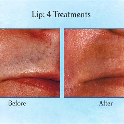 Lip: 4 Treatments