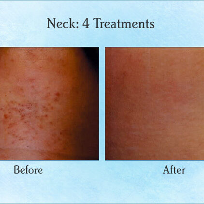 Neck: 4 Treatments